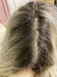 Система замещения волос